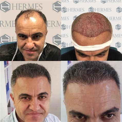 hermes hair clinic yorumlar|Hermes hair clinic istanbul.